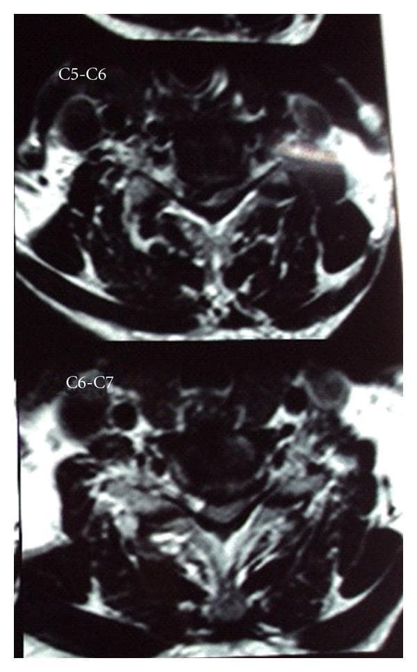 This diagnostic image consists of two axial T2-weighted magnetic resonance imaging (MRI) slices of the cervical spine, labeled at the C5-C6 and C6-C7 levels. The images demonstrate significant right paracentral disc herniation at both levels, resulting in pronounced hemicord compression. At the C5-C6 level, the herniated disc material is seen extruding into the spinal canal, causing asymmetric flattening and displacement of the spinal cord toward the left. Similar pathological findings are observed at the C6-C7 level, though the compression at C5-C6 appears more severe. The vertebral bodies and surrounding soft tissues show signs of degenerative spondylosis. The visual evidence of unilateral cord compression is a classic radiological correlate for Brown-Séquard syndrome, illustrating the mechanical etiology of ipsilateral motor loss and contralateral sensory deficits. This material is suitable for intermediate to advanced medical learners focusing on neuroradiology, orthopedics, or neurology.