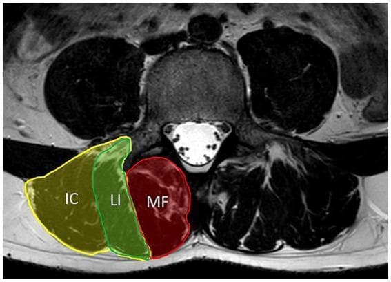 This diagnostic image is an axial T2-weighted MRI of the lumbar spine at the L4 level, illustrating the cross-sectional anatomy of the paraspinal musculature. The central vertebral body exhibits intermediate signal intensity, with the posterior spinal canal appearing hyperintense due to cerebrospinal fluid. On the left side of the image, the paraspinal muscles are highlighted and labeled to demonstrate their spatial relationships: the multifidus (MF) is positioned most medially, immediately adjacent to the spinous process and lamina. Lateral to the multifidus is the erector spinae group, subdivided into the longissimus (LI) muscle medially and the iliocostalis (IC) muscle most laterally. These muscles are characterized by intermediate to low signal intensity on the T2 sequence. This visual resource is essential for understanding core stabilization anatomy and evaluating clinical conditions such as axial myopathy, muscular atrophy, or fatty infiltration in patients with chronic low back pain or neuromuscular disorders like myotonic dystrophy.