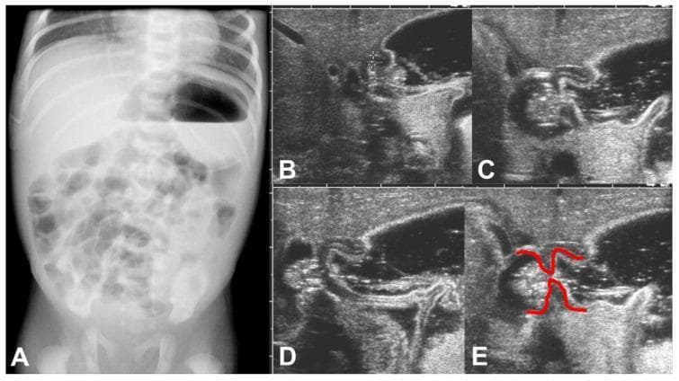 This composite figure presents multimodality imaging of a neonate with hypertrophic pyloric stenosis (HPS). Panel A shows an erect anteroposterior plain abdominal X-ray, demonstrating a significantly dilated stomach with a prominent air-fluid level, indicative of gastric outlet obstruction. Small bowel gas distribution appears distal but sparse. Panels B-E display a temporal sequence of abdominal ultrasonography focused on the pyloric region. The grayscale images show a thickened, elongated pyloric canal with failed passage of gastric contents during active peristaltic waves. In Panel E, red annotations highlight the 'shouldering' sign, where the thickened pyloric muscle bulges into the gastric antrum. Educational features include the hallmark radiographic finding of gastric distension and the sonographic characteristics of a non-relaxing, hypertrophic pylorus, which are critical for the diagnosis of HPS in pediatric radiology.