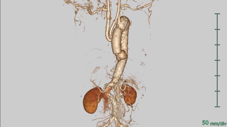 A postoperative 3D reconstructed computed tomography (CT) scan of the human aorta and its branches. The image highlights a partial arch replacement for acute aortic dissection in a patient with a bovine arch variant. The ascending aorta and a portion of the arch have been replaced with a vascular graft, which appears as a segmented tubular structure with distinct anastomotic lines. The supra-aortic vessels show surgical reconstruction: a branched graft is visible originating from the main aortic graft to supply the innominate artery (brachiocephalic trunk) and the left common carotid artery. This reconstruction followed the resection of a dilated proximal innominate artery. The descending aorta continues inferiorly, leading to the visualization of the abdominal aorta, bilateral renal arteries, and kidneys. There is no evidence of residual contrast-enhanced false lumen or dissection flaps within the reconstructed segments. This diagnostic visualization is used to assess surgical integrity and blood flow following complex cardiothoracic repair of the aortic arch.