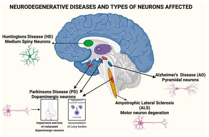 Educational medical illustration titled 'Neurodegenerative Diseases and Types of Neurons Affected' featuring a sagittal cross-section of the human brain alongside specialized neuronal diagrams. The brain section highlights key anatomical areas susceptible to degeneration: the striatum (green) for Huntington’s Disease (HD), cortical and hippocampal regions (pink neurons) for Alzheimer’s Disease (AD), the substantia nigra and midbrain (red) for Parkinson’s Disease (PD), and the brainstem and spinal pathways (orange) for Amyotrophic Lateral Sclerosis (ALS). The diagram categorizes specific neuronal vulnerabilities: Medium Spiny Neurons in HD, Pyramidal neurons in AD, and Motor neuron degeneration in ALS. For Parkinson's Disease, detailed insets illustrate the pathophysiology of dopaminergic neurons, showing the impairment and loss of melanated cells, alpha-synuclein protein aggregation, and the formation of Lewy bodies. The visual serves as a summary of the neuroanatomical localization and cellular pathology characteristic of major neurodegenerative disorders.