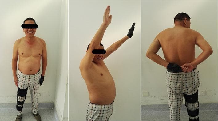 This set of clinical photographs demonstrates functional outcomes and range of motion (ROM) 6 months postoperatively following treatment for a humeral shaft fracture and associated deltoid palsy. The image displays three views of a male patient: 1) Anterior view showing a neutral standing posture with a leg brace on the left lower extremity. 2) Lateral view demonstrating active forward flexion and abduction of the shoulders, with the right arm showing near-full vertical elevation. 3) Posterior view illustrating internal rotation and adduction as the patient reaches behind the back to touch hands at the lumbar level. The series illustrates the clinical recovery of shoulder mobility and the resolution of postoperative nerve injury (deltoid palsy). A visible scar is noted on the lateral aspect of the right proximal arm, consistent with surgical access for internal fixation. These images serve as an educational resource for assessing orthopedic recovery and functional musculoskeletal rehabilitation.