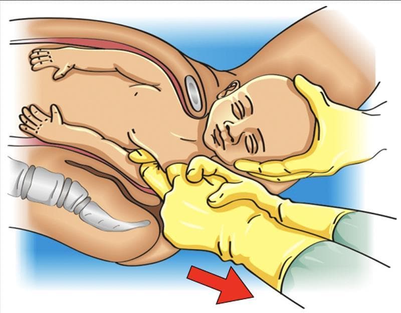 This medical illustration depicts the Menticoglou maneuver, a specialized obstetric technique used to resolve shoulder dystocia by delivering the posterior shoulder. The fetus is shown in the birth canal with the head partially delivered. The clinician's hands, wearing yellow gloves, are performing axillary traction. The middle fingers of both hands are interlaced within the fetal posterior axilla (axillary cavus) to gain a secure grip. A red arrow indicates the application of inferior traction force directed along the maternal sacral curvature. This maneuver aims to facilitate the descent of the posterior shoulder, thereby reducing the biacromial diameter and allowing the impacted anterior shoulder to dislodge from the maternal pubic symphysis. The diagram serves as an educational tool for emergency obstetric management, highlighting hand placement and the mechanical vector required to resolve impaction when primary maneuvers like McRoberts or Rubin I have failed.