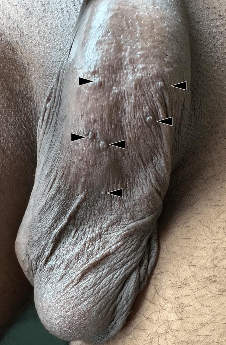 This clinical photograph shows a close-up view of the human scrotum. The scrotal skin exhibits numerous, discrete, small (1-4 mm) dome-shaped papules distributed across its surface, as highlighted by black arrowheads. The lesions present a reddish-brown to dusky-red hue, contrasting against the hyperpigmented scrotal skin. The texture of some papules appears slightly hyperkeratotic or smooth, while the surrounding background skin maintains its characteristic wrinkled and folded appearance. These findings are clinically characteristic of angiokeratoma of Fordyce, a benign vascular dermatosis involving ectatic superficial dermal vessels. The image serves as an educational reference for dermatological examination of male genital lesions, emphasizing morphology, color, and clustered distribution patterns typical of vascular-origin papules in this anatomical region.