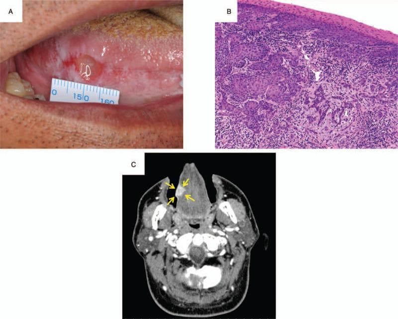 A multi-panel figure illustrating the clinical, histopathological, and radiological findings of oral squamous cell carcinoma. Panel A is a clinical photograph of the oral cavity showing a lesion on the right lateral border of the tongue. The lesion presents with an irregular, ulcerated surface and associated leukoplakia; a surgical ruler is positioned for scale, measuring approximately 7 x 10 mm. Panel B shows a histopathological section of the biopsy stained with hematoxylin and eosin (H&E) at 20x magnification. The tissue exhibits invasive nests of malignant epithelial cells with characteristic squamous differentiation and surrounding inflammatory cell infiltration, confirming squamous cell carcinoma. Panel C is an axial contrast-enhanced computed tomography (CT) scan of the head and neck. Yellow arrows highlight a hyperdense, contrast-enhancing mass on the right side of the tongue, measuring 18 mm in width and 11 mm in depth. This composite image is designed for educational use in oncology and oral surgery to demonstrate the diagnostic workflow for tongue cancer.