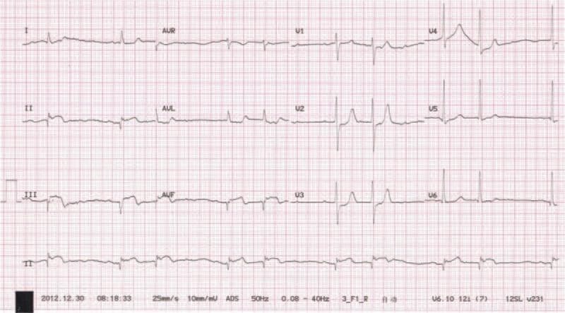 A 12-lead diagnostic electrocardiogram (ECG) tracing displaying classic signs of an inferior wall myocardial infarction (MI). The tracing exhibits significant convex-upwards ST-segment elevation (Pardee waves) and T-wave inversions in the inferior leads (II, III, and aVF). Notably, deep and wide pathological Q waves are present in these same leads, suggesting myocardial necrosis or a completed infarction sequence. Additionally, the rhythm strip demonstrates evidence of a second-degree atrioventricular (AV) block, characterized by a non-conducted P wave following a consistent PR interval pattern. Reciprocal ST-segment depression is visible in the lateral leads (I, aVL), a common finding in acute inferior ST-elevation myocardial infarction (STEMI). This visual provides critical educational evidence for diagnosing coronary artery occlusion, specifically involving the right coronary artery (RCA) or left circumflex artery, and illustrates the potential conduction system complications associated with inferior wall damage.