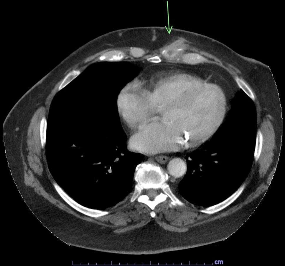 This diagnostic image is an axial chest computed tomography (CT) scan with intravenous contrast. The focus is on the anterior left chest wall at the level of the lower mediastinum. An arrow indicates a focal area of pathology involving the left seventh costal cartilage. Key findings include localized soft tissue thickening and a hypoattenuating fluid collection approximately 0.9 x 0.6 cm in size, characteristic of an abscess or persistent fluid collection associated with costochondritis. There is evidence of a sinus tract extending from this deep collection toward the skin surface. Centrally, the mediastinum contains the heart and great vessels, with visible calcifications within the coronary arteries. The lungs are clear without significant consolidation or pleural effusion. The vertebral bodies and posterior ribs appear intact. This scan is educationally significant for demonstrating the radiological appearance of infectious costochondritis and associated chest wall abscess formation, which in this clinical context was confirmed to be caused by Salmonella enterica serotype Choleraesuis.