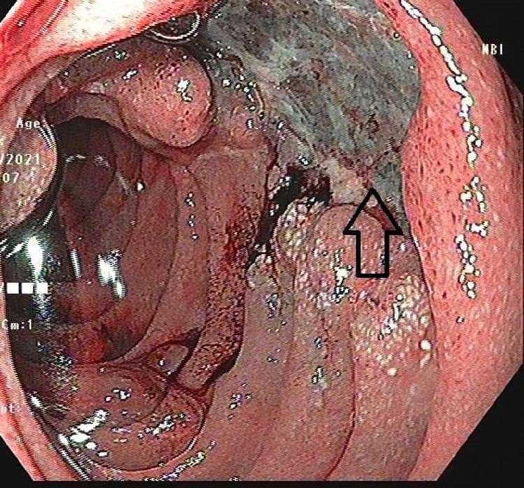 This clinical photograph displays an upper gastrointestinal endoscopy (UGIE) view of the second part of the duodenum. The primary finding is a large, irregularly shaped ulcer approximately 2x2 cm in size, situated on the medial wall. The ulcer features prominent nodular margins and a base covered with dark, necrotic-appearing material and focal areas of hemorrhage. An arrow indicates the close anatomical proximity of the lesion to the duodenal papilla. The surrounding duodenal mucosa is erythematous and inflamed, with thickened, irregular folds and a granular texture suggestive of significant tissue reaction. This endoscopic view is critical for the differential diagnosis of duodenal pathologies, including malignancy (duodenal adenocarcinoma), complex peptic ulcer disease, or atypical presentations of granulomatous diseases like tuberculosis or groove pancreatitis. The image illustrates key markers for malignancy or chronic inflammation, such as nodularity and mucosal distortion.