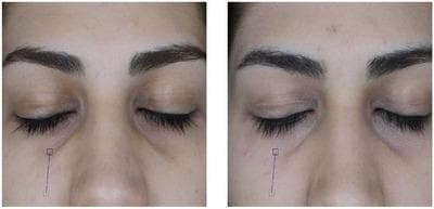 This clinical photograph is a side-by-side comparison chart showing the 'before' and 'after' results of carboxytherapy for dark under-eye circles (DUC) in a patient with Fitzpatrick skin type 3. The images provide a close-up view of the periorbital and infraorbital regions with eyes closed. The 'before' image (left) demonstrates significant infraorbital hyperpigmentation characterized by a dark, shadowed appearance in the tear trough area, along with fine lines and visible micro-vessels beneath the lower eyelid. The 'after' image (right) shows a visible reduction in pigmentation, resulting in a more even skin tone and decreased shadowing. Additionally, there is a subtle improvement in skin texture with a softened appearance of fine lines and a reduction in the prominence of superficial vascularity. This comparison illustrates the clinical effectiveness of carboxytherapy in improving microcirculation and reducing localized hyperpigmentation in the dermatological management of aesthetic periorbital concerns.