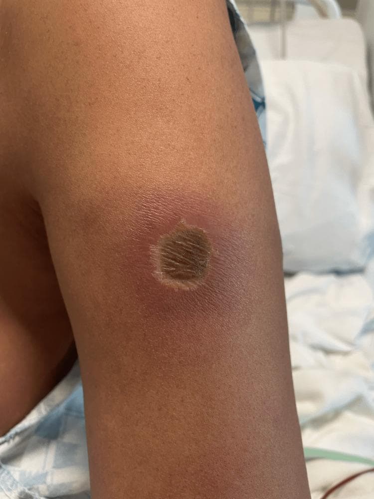 Clinical photograph of a skin lesion on the left upper extremity, characteristic of a brown recluse spider bite (Loxoscelism). The lesion exhibits a classic 'red, white, and blue' sign of envenomation. It features a central, depressed necrotic core that is dark brown and textured, indicating early dermal necrosis. Immediately surrounding the necrotic center is a pale, ischemic ring (central pallor). The outermost region consists of a well-defined area of erythema and inflammatory edema, which gradually fades into the surrounding normal skin. This appearance illustrates the progression of venom-induced tissue destruction, involving localized vasoconstriction and neutrophil-mediated inflammation leading to liquefactive necrosis. This image is an educational example of cutaneous arachnoidism and the diagnostic morphology used to identify necrotizing spider bites in a clinical setting.
