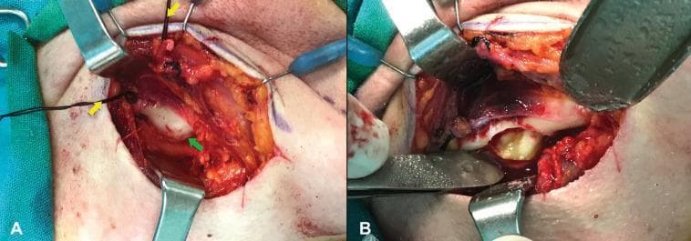Two-panel clinical photograph illustrating an extraoral surgical approach for an ectopic mandibular third molar. Figure A shows the surgical site after a submandibular incision and elevation of the periosteum of the mandibular body. Yellow arrows indicate black silk ligatures on the facial artery and vein, used to safely retract the marginal mandibular branch of the facial nerve from the operative field. A green arrow points to a localized bony expansion on the mandibular surface representing the impaction site. Figure B depicts the same site following a buccal plate osteotomy. The removal of the overlying bone reveals an impacted tooth (yellowish-white structure) surrounded by dark, cystic soft tissue, later identified as a dentigerous cyst. This sequence demonstrates maxillofacial surgical techniques for managing deep mandibular impactions while protecting vital neurovascular structures, specifically the facial nerve (Cranial Nerve VII).