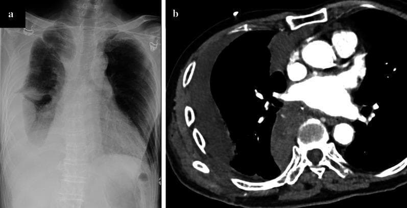 This dual-panel diagnostic image demonstrates a massive right-sided hemothorax in a post-surgical patient. Panel (a) is a posterior-anterior (PA) chest X-ray showing significant homogeneous opacity in the right lower and mid-lung fields, resulting in the obscuration of the right diaphragmatic contour and costophrenic angle. There is a blunting effect and upward-sloping meniscus characteristic of a large pleural effusion. Panel (b) is an axial contrast-enhanced CT scan of the chest at the level of the pulmonary arteries. It reveals a large, high-density fluid collection (consistent with acute blood) within the right pleural space. This collection causes significant passive atelectasis of the right lung, which is compressed medially against the mediastinum. The mediastinal structures remain relatively midline, though the volume of the right hemithorax is notably increased compared to the clear left hemithorax. These findings are clinically significant for diagnosing postoperative hemorrhage, specifically an intercostal artery injury in the context of thoracic surgery.