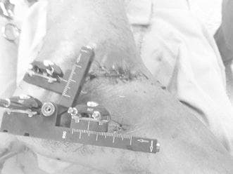 A clinical photograph of an external fixator applied to the hindfoot and ankle region, likely for the management of a calcaneal fracture. The metal device features a primary horizontal rail and a secondary adjustable arm, both containing graduated measurement scales for controlled distraction and fragment reduction. Multiple percutaneous pins are seen entering the soft tissue, secured to the fixator via adjustable locking clamps. Adjacent to the hardware, a linear surgical incision closed with sutures is visible over the lateral aspect of the foot (sinus tarsi area). The surrounding skin shows mild postoperative edema and bruising, consistent with acute surgical trauma. This visual demonstrates the mechanical setup for ligamentotaxis and anatomical alignment in orthopedic trauma surgery, emphasizing pin placement and skin clearance for postoperative swelling.
