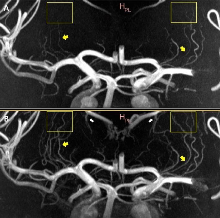 This Comparison Chart features two coronal plane Maximum Intensity Projection (MIP) diagnostic images evaluating intracranial vasculature using Magnetic Resonance Angiography (MRA). Image A displays a standard Time-of-Flight (ToF) MRA, while Image B shows a Contrast-Enhanced (CE) ToF MRA. The images highlight the Circle of Willis and its branches, specifically the Middle Cerebral Artery (MCA) and the Lenticulostriate Arteries (LSAs). Yellow arrows and boxes indicate regions where CE ToF MRA (B) provides superior signal intensity and improved sharpness of distal LSA branches compared to the signal loss seen in standard ToF (A). Additionally, white arrows in Image B demonstrate the increased prominence of the venous system, including the Choroidal and Thalamostriate veins draining into the Internal Cerebral Veins. This visual comparison illustrates the diagnostic advantages of contrast enhancement in improving small vessel visualization and reducing signal drop-off, though it introduces mild venous contamination. The content is suitable for neuroradiology education focusing on vascular imaging techniques and neuroanatomy.