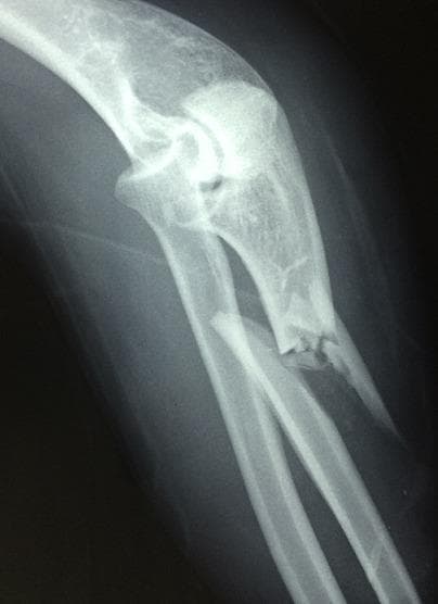 A lateral view X-ray of the elbow and proximal forearm demonstrating a Monteggia fracture-dislocation. The radiograph reveals a comminuted fracture of the proximal ulnar shaft with significant displacement and angulation. Associated with this fracture is an anterior dislocation of the radial head, which no longer articulates correctly with the humeral capitellum. The proximal radius is shifted anteriorly relative to the distal humerus, confirming the diagnostic pattern of a Bado Type I Monteggia injury. The image serves as a clinical example of musculoskeletal trauma, highlighting the importance of assessing the integrity of the radiocapitellar joint in the presence of ulnar fractures. The radiograph clearly illustrates the disruption of the normal anatomical alignment between the humerus, radius, and ulna at the elbow joint.