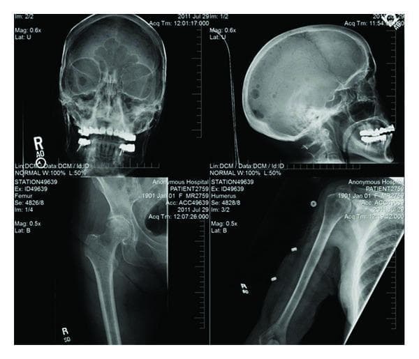 This diagnostic composite image presents a radiographic skeletal survey consisting of four X-ray views: an AP and lateral view of the skull (top row), a proximal femur/pelvis view (bottom left), and a humerus view (bottom right). The skull radiographs demonstrate classic 'punched-out' lytic lesions, particularly visible in the lateral projection as multiple, discrete, circular areas of radiolucency throughout the calvarium. Similar diffuse lytic lesions and areas of cortical thinning are evident in the diaphysis and metaphysis of the humerus and the proximal femur. These findings are characteristic of plasma cell dyscrasias, such as multiple myeloma, or other osteolytic metastatic processes. The distribution across both flat and long bones highlights systemic skeletal involvement. Medical educators can use this image to illustrate the radiographic hallmarks of multiple myeloma and differentiate lytic bone destruction from blastic lesions in an oncologic or hematologic context.