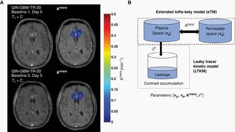 This figure presents clinical diagnostic imaging and a pathophysiology diagram related to neuro-oncology and perfusion MRI. Panel A displays axial T1-weighted post-contrast Dynamic Contrast-Enhanced MRI (DCE-MRI) scans and corresponding parametric maps of the volume transfer constant (Ktrans) for a glioblastoma patient (QIN-GBM-TR-20) at two time points: Baseline 1 (Day 0) and Baseline 2 (Day 5). The parametric maps utilize a color-coded heat map (scale 0 to 0.5 min⁻¹) to illustrate localized areas of high vascular permeability, primarily located in the central periventricular region. Panel B is a compartmental model diagram contrasting the Extended Tofts-Kety Model (eTM) with the Leaky Tracer Kinetic Model (LTKM). It illustrates the exchange between the plasma space (vp) and the extravascular extracellular space (ve) via Ktrans, while the LTKM introduces an additional leakage compartment governed by the rate constant λtr. This educational material focuses on the quantitative assessment of tumor hemodynamics and the repeatability of pharmacokinetic modeling in brain tumor imaging.