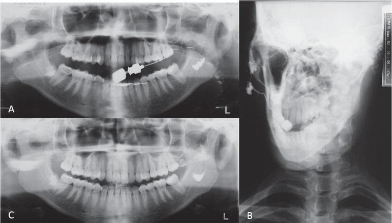 This set of diagnostic radiographs illustrates a sialography procedure of the left parotid gland. Figure A shows a panoramic view immediately following the injection of a radiopaque contrast medium (Lipiodol), with an intraoral cannula visible. Figure B provides an anteroposterior (AP) view, demonstrating the distribution of the contrast within the parotid ductal system and gland parenchyma, superimposed against the mandible and cervical spine. Figure C is a follow-up panoramic radiograph taken 24 hours later, highlighting significant contrast retention. The images reveal 'cavitary sialectasia,' characterized by irregular, globular collections of contrast medium within the gland, indicating damage to the ductal epithelium. The surrounding maxillofacial bony structures, including the mandible, maxilla, and alveolar bone, appear radiographically normal. This series is an educational example of salivary gland imaging used to diagnose chronic inflammatory conditions or obstructive sialadenitis by visualizing ductal morphology and glandular evacuation efficiency.