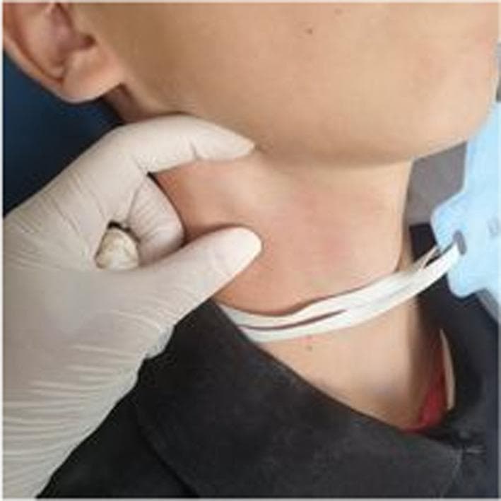 This clinical photograph displays a lateral view of a pediatric patient's right neck, highlighting the submandibular region. A medical professional, wearing a white nitrile glove, is performing physical palpation of a visible anatomical abnormality. The key finding is a localized, rounded swelling or bulge measuring approximately 3 cm in the right submandibular area, consistent with lymphadenopathy. The overlying skin exhibits mild erythema compared to the adjacent cervical tissue but remains intact without ulceration or drainage. The image demonstrates the clinical examination technique for assessing cervical lymph nodes, specifically focused on size, mobility, and contour in the context of oral or systemic infection. The presence of a surgical face mask around the patient's neck and a dark shirt collar provide additional orientation.