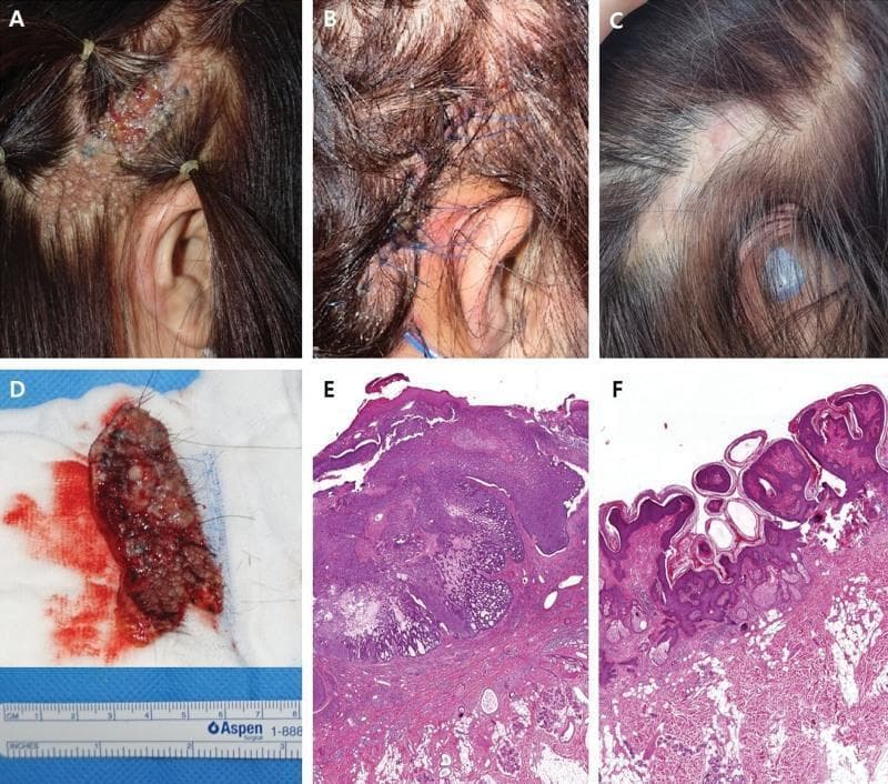 A multi-panel medical figure documenting the clinical presentation, surgical management, and histopathology of basal cell carcinoma (BCC) arising from nevus sebaceous (NS). (A) Clinical photograph of the right temporal scalp showing a linear, brownish, verrucous plaque (NS) with focal blackish nodules and superficial ulceration, suggestive of malignant transformation. (B) Immediate postoperative view showing a local flap reconstruction with blue nylon sutures covering the excision site. (C) Long-term follow-up showing a stable, well-healed surgical scar with appropriate hair coverage. (D) Gross surgical specimen on gauze, measuring approximately 8 cm in length, showing the excised cutaneous lesion. (E) Hematoxylin and eosin (H&E) stained micrograph at low magnification demonstrating BCC characterized by basaloid epithelial cell nests with distinct peripheral palisading and stromal retraction. (F) H&E stained micrograph of the background NS lesion, highlighting epidermal papillomatosis, verrucous hyperplasia, and prominent sebaceous glands. This sequence illustrates the clinical progression and diagnostic features of secondary malignancy within a congenital sebaceous nevus.