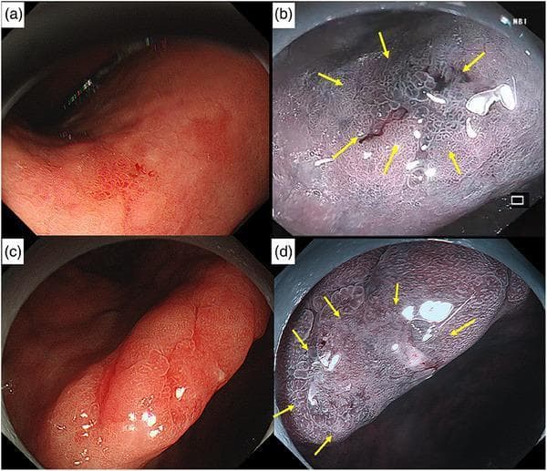 This set of diagnostic images showcases early gastric cancer (EGC) using endoscopy in the stomach. Panels (a) and (c) display conventional white light imaging (WLI), revealing small (7–8 mm), reddish, superficial depressed lesions (Paris classification 0-IIc) located at the lesser curvature of the lower corpus and the incisura angularis, respectively. Panels (b) and (d) utilize Narrow Band Imaging (NBI) and magnified NBI to enhance visualization of the pathology. These images clearly demonstrate an irregular mucosal surface pattern and irregular microvascular architecture, both delimited by a sharp demarcation line (indicated by yellow arrows) that separates the malignant tissue from the surrounding atrophic gastric mucosa. The findings are characteristic of well-differentiated early gastric adenocarcinoma limited to the lamina propria. These visuals serve as educational examples of utilizing advanced endoscopic modalities to identify subtle neoplastic changes in the setting of chronic atrophic gastritis and Helicobacter pylori infection.