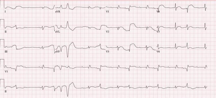 A standard 12-lead electrocardiogram (ECG) demonstrating complex cardiac rhythm disturbances. The primary rhythm shows a complete atrioventricular (AV) block (third-degree heart block), characterized by a lack of relationship between P waves and QRS complexes. A junctional escape rhythm is present, featuring widened QRS complexes (>120 ms). Leads V1 through V3 exhibit a Right Bundle Branch Block (RBBB) morphology with broad, predominantly positive QRS complexes. The tracing also captures a significant premature ventricular contraction (PVC) burden, including a period of ventricular bigeminy and a brief run of non-sustained ventricular tachycardia (NSVT). Notable findings include a prolonged corrected QT interval (QTc) of approximately 522 ms. There is no evidence of acute ST-segment elevation or depression. This ECG illustrates severe conduction system disease and ventricular irritability, clinically relevant in the context of drug-induced cardiotoxicity or myocarditis.