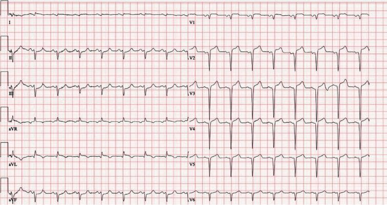 This is a 12-lead electrocardiogram (ECG) demonstrating an acute ST-segment elevation myocardial infarction (STEMI). The diagnostic hallmark is prominent ST-segment elevation across the precordial leads V1 through V6, with the most significant convex elevation appearing in leads V2, V3, and V4. These findings are highly characteristic of an acute anterior wall infarction, typically involving the left anterior descending (LAD) coronary artery. In the limb leads, mild ST-segment elevation is also visible in leads I, II, III, and aVF, accompanied by positive, upright T waves. Lead aVR shows expected global inversion. The tracing displays a sinus rhythm with regular morphology, but the ST-segment deviations from the isoelectric baseline indicate acute myocardial injury. This visual material is a critical educational tool for teaching the ECG localization of coronary occlusions and the identification of STEMI criteria in an emergency clinical context.