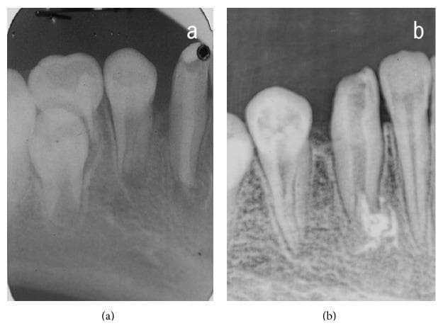 A comparison of two periapical radiographs (labeled a and b) documenting the endodontic management of an immature permanent mandibular tooth. Image (a), from the monitoring phase, reveals a tooth with significant coronal loss and an underdeveloped root characterized by a wide, divergent, or 'blunderbus' open apex. The surrounding alveolar bone is visible, and neighboring teeth show developing structures. Image (b), from the treatment phase, demonstrates the radiographic outcome after endodontic intervention. The root canal is now obturated with radiopaque filling material, likely following apexification or an apical plug procedure to address the previous open apex. The coronal portion shows signs of restoration. These images serve as an educational example of managing immature teeth with pulpal pathology, highlighting the transition from an open apex state to controlled root canal obturation.