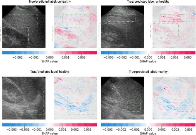 This diagnostic comparison chart features synthetic B-mode liver ultrasound images alongside SHAP (Shapley Additive Explanations) heatmaps, illustrating the classification of Nonalcoholic Fatty Liver Disease (NAFLD). The top row showcases 'unhealthy' cases characterized by increased liver echogenicity (hyperechoic) relative to the renal cortex and blurred hepatic vein boundaries, indicative of hepatic steatosis. The bottom row displays 'healthy' cases with iso-echogenic patterns between the liver and kidney and well-defined vascular structures. Each ultrasound image is paired with a SHAP value heatmap where red pixels indicate positive contributions toward an 'unhealthy' classification (concentrated in the liver and kidney cortex of fatty livers) and blue pixels indicate features contributing to a 'healthy' classification (focused on clear diaphragmatic and portal vein boundaries). Green dotted rectangles highlight specific regions of interest used by the CNN classifier to differentiate between normal and diseased liver states. This visual aid is designed for advanced medical imaging informatics and radiology education regarding AI-driven diagnostic features in hepatology.