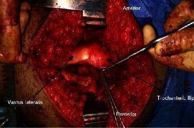 This clinical photograph captures a surgical procedure involving a trochanteric osteotomy of the hip, commonly utilized in surgical hip dislocation. The image shows a deep lateral incision centered over the greater trochanter, with soft tissue retracted to expose the musculoskeletal structures. Key anatomical landmarks are annotated: the 'Anterior' and 'Posterior' orientations are marked to provide spatial context. A 'Trochanteric flip' is indicated by an arrow, showing the mobile osteotomized fragment of the greater trochanter being displaced anteriorly. The 'Vastus lateralis' is also labeled, illustrating its relationship to the surgical site and its mobilization as part of the digastric trochanteric flap. Surgical retractors and elevators are visible within the field, reflecting active tissue manipulation to expose the underlying joint capsule. This visual demonstrates the surgical approach used for conditions such as Slipped Capital Femoral Epiphysis (SCFE) or femoroacetabular impingement, highlighting the preservation of the blood supply to the femoral head via the retinacular vessels.