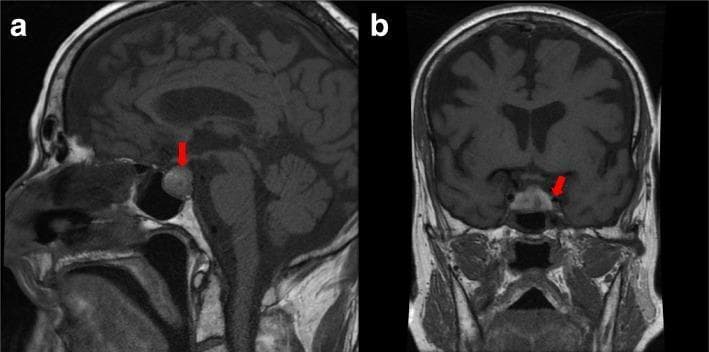Contrast-enhanced brain magnetic resonance imaging (MRI) scans in sagittal (a) and coronal (b) views demonstrating a significant pituitary lesion. Red arrows point to a markedly enlarged pituitary gland that expands the sella turcica. The lesion exhibits heterogeneous signal intensity, characterized by varying degrees of contrast enhancement and distinct areas of intrinsic high signal, which are visually suggestive of intra-lesional hemorrhage or necrosis. In the sagittal view, superior expansion of the mass is visible relative to the sphenoid sinus and brainstem. The coronal view highlights the horizontal extension and proximity to the cavernous sinuses. These neuroimaging findings are clinically significant for diagnosing pituitary apoplexy, often occurring in the setting of a preexisting macroadenoma. The images serve as an educational example of sellar pathology, demonstrating the diagnostic utility of multi-planar MRI in evaluating the hypothalamic-pituitary axis and identifying complications such as hemorrhage within a pituitary mass.