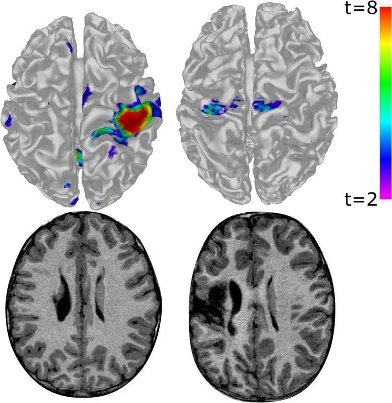 This composite diagnostic image features functional magnetic resonance imaging (fMRI) surface maps (top row) and corresponding T1-weighted axial structural scans (bottom row) of two pediatric patients with unilateral cerebral palsy. The left column illustrates a child with higher motor function performing a hand-tapping task with the less-impaired hand; fMRI demonstrates robust, focal, unilateral activation in the contralateral sensorimotor cortex, specifically at the 'hand knob' landmark. The right column illustrates a child with significant brain damage performing the task with the more-impaired hand. The top-right fMRI shows atypical, bilateral, and more medial/anterior activation concentrated in the supplementary motor areas (SMA), suggesting functional reorganization. The bottom-right T1 image reveals a clear periventricular lesion with altered signal intensity and tissue loss compared to the relatively preserved cortical morphology in the bottom-left image. A color scale indicates t-values from 2 to 8, representing the statistical significance of hemodynamic response. This comparison highlights the neuroplastic adaptation of motor control pathways following early-life brain injury.