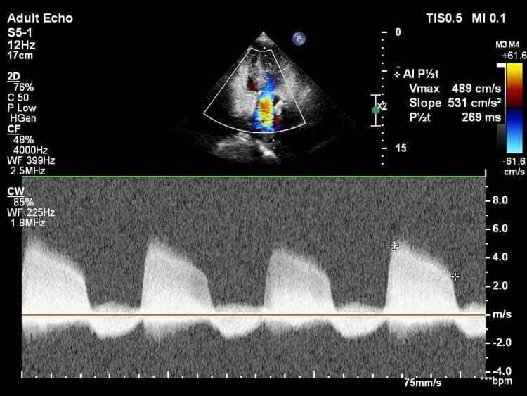 A transthoracic echocardiogram (TTE) image utilizing color Doppler and continuous wave (CW) Doppler to assess aortic regurgitation. The upper panel displays an apical view where color Doppler identifies a high-velocity, mosaic-patterned jet originating from the aortic valve and directed into the left ventricle, indicating significant regurgitant flow. The lower panel shows the corresponding CW spectral Doppler waveform. The waveform exhibits a dense, holodiastolic signal with a peak velocity (Vmax) of 489 cm/s. Quantitative analysis is annotated on the screen, showing a pressure half-time (P½t) of 269 ms and a deceleration slope of 531 cm/s², parameters used to grade the severity of aortic insufficiency. The visual evidence of a well-defined spectral envelope and the calculated P½t are characteristic findings in moderate to severe chronic aortic regurgitation.