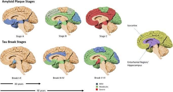 This medical schematic illustrates the neuroanatomical progression of Alzheimer’s disease pathology across different brain stages, focusing on amyloid-beta (Aβ) plaques and tau protein neurofibrillary tangles. The top row depicts Amyloid Plaque Stages A through C, showing a progression from localized mild density (blue) in the basal neocortex to moderate (green) and severe (red) densities as plaques spread throughout the isocortex. The bottom row displays the Tau Braak Stages (I-VI). Stages I-II show initial mild tau accumulation in the entorhinal region and hippocampus. Stages III-IV visualize moderate density spreading to the limbic system, while Stages V-VI demonstrate severe, widespread tau pathology throughout the isocortex. A color-coded legend indicates pathology density: blue for mild, green for moderate, and red for severe. An anatomical reference on the right identifies key regions like the Isocortex and Entorhinal Region/Hippocampus. Timelines below suggest a clinical progression spanning 30 to 48 years, highlighting the long-term nature of neurodegeneration.