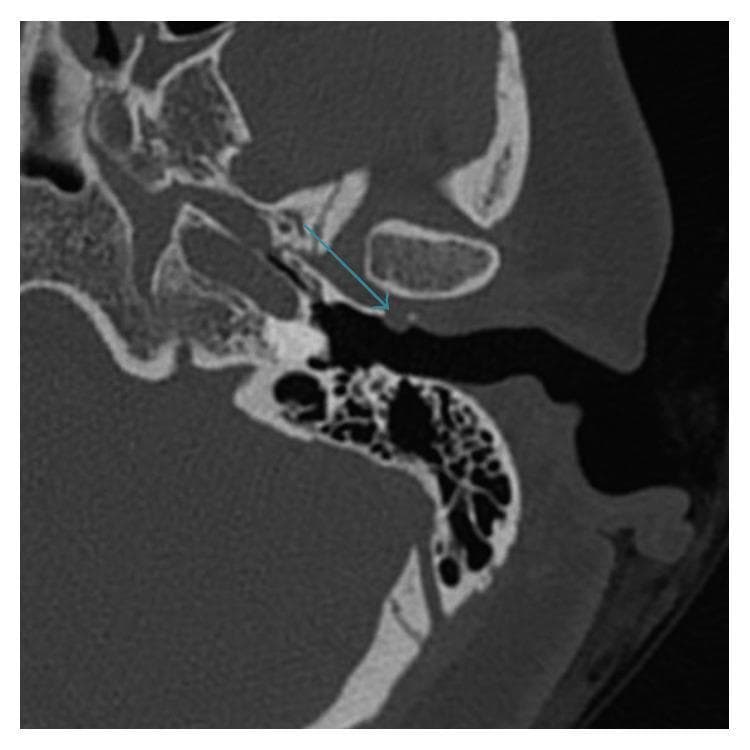 This diagnostic image is an axial non-contrast computed tomography (CT) scan of the left temporal bone, presented in bone window settings. It demonstrates the anatomical relationships between the temporomandibular joint (TMJ), external auditory canal (EAC), and middle ear structures. A blue arrow highlights a small, well-defined, rounded cystic lesion with fluid density arising from the anterior-inferior wall of the external auditory canal. The lesion is located in close proximity to the posterior aspect of the TMJ condyle, consistent with a TMJ ganglion cyst. The surrounding temporal bone anatomy, including the mastoid air cells, ossicular chain, and petrous portion of the temporal bone, appears normal. This image illustrates a rare cause of EAC masses, highlighting the importance of radiological imaging in differentiating TMJ-related pathologies from primary otologic conditions. It is a key educational example for radiology and otolaryngology trainees regarding the differential diagnosis of cystic lesions of the ear canal.