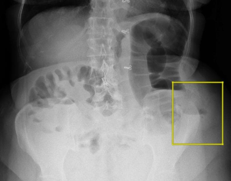 This diagnostic image is a plain erect abdominal radiograph (X-ray) demonstrating signs of intestinal obstruction. The radiograph reveals multiple significantly dilated loops of small and large bowel distributed across the abdominal cavity. Characteristic multiple air-fluid levels are visible, representing the gravitational separation of liquid and gas within the distended lumen. A yellow square highlights the left lower quadrant (left iliac region), where focal dilated bowel loops and prominent air-fluid levels are concentrated near the iliac crest. These findings are clinically significant as they indicate a mechanical bowel obstruction or a localized paralytic ileus. The image serves as a teaching tool for identifying radiological hallmarks of intestinal distension and fluid stasis in acute surgical abdominal presentations, specifically correlating with bowel herniation through an iliac crest defect.