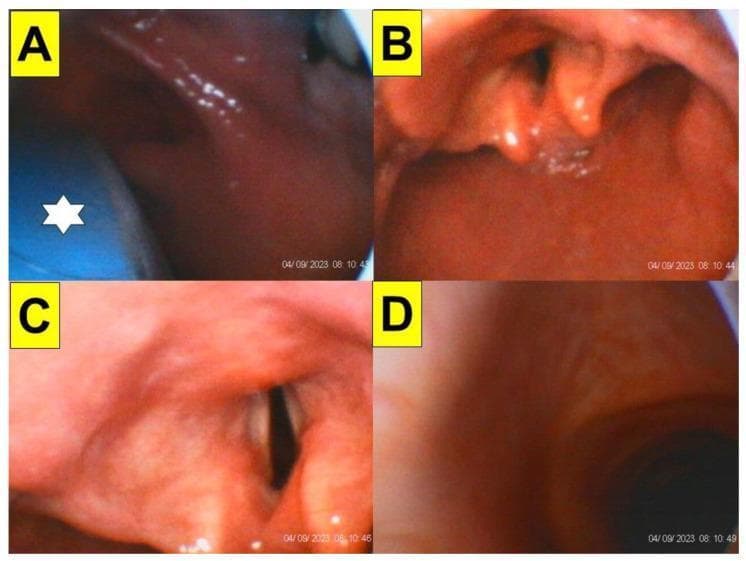 A series of four endoscopic frames (A-D) documenting a tracheal intubation procedure using a video-assisted stylet (styletubation) in an obese patient. Image A illustrates the initial laryngoscopy phase, showing the blue blade of a video laryngoscope (marked with a white star) positioned within the oropharynx. Image B displays the successful exposure of the glottic opening and epiglottis prior to stylet insertion. Image C provides a clear, magnified view of the vocal cords and the dark laryngeal inlet achieved via the optical stylet. Image D captures the final advancement, showing the distal view of the tracheal lumen and rings. The series demonstrates the clinical application of combining video laryngoscopy with a video-intubating stylet to manage potentially difficult airways in patients with high BMI, where redundant pharyngeal soft tissues may obscure direct visualization. This educational sequence highlights key anatomical landmarks including the epiglottis, arytenoid cartilages, vocal cords, and trachea.