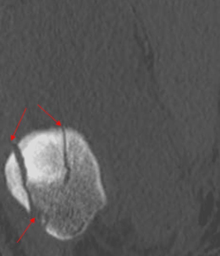 This diagnostic image is a coronal CT scan focused on the patella of the right knee. The scan demonstrates a comminuted patellar fracture, characterized by multiple fracture lines indicated by red arrows. Two distinct vertical fracture planes are visible, dividing the patella into at least three separate fragments. These fracture lines extend through the bony matrix, disrupting the cortical integrity and smoothing of the articular surface. The surrounding soft tissues show uniform density without gross displacement, though the primary focus remains on the integrity of the patellar bone. This image is illustrative of orthopedic trauma and the use of advanced imaging in assessing complex fracture patterns for surgical planning. It is intended for medical students and orthopedic residents to understand the classification and visualization of intra-articular knee fractures.