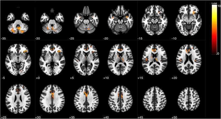 This diagnostic image is a series of 18 axial MRI brain slices displaying Voxel-Based Morphometry (VBM) results. The slices are arranged sequentially from inferior to superior, with z-axis coordinates labeled from -35 to +50. The background provides anatomical detail in grayscale, while a heat-map overlay (red-to-yellow) highlights areas of statistically significant gray matter atrophy in patients with Cerebral Small Vessel Disease (CSVD) compared to healthy controls. A color-coded t-statistic scale (ranging from 0 to 10) indicates the degree of volume loss, with yellow representing the highest significance (p < 0.0001). Key anatomical regions exhibiting atrophy include the bilateral cerebellum (visible at z = -35 to -25), the right thalamus and inferior frontal gyrus (z = +5 to +15), and the anterior and medial cingulate cortices (z = +25 to +40). This visual serves as a neuroimaging demonstration of structural brain changes associated with CSVD and potential cognitive or autonomic dysfunction.