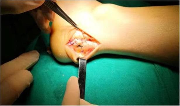 This clinical photograph shows an intraoperative view of an Achilles tendon reattachment procedure on a human heel. The surgical field is exposed via a lateral longitudinal incision near the calcaneal insertion. Metal surgical instruments, including a hand-held retractor and toothed forceps, are being used to provide visualization and tissue retraction. Within the open wound, the distal Achilles tendon is visible, secured to the calcaneus using a single-row suture anchor technique. Several dark, non-absorbable sutures are knotted over the white fibrous tendon tissue to maintain tension and proximity to the bone. The surrounding skin is draped with green surgical cloths and exhibits mild perisurgical erythema. This image serves as an educational reference for orthopedic foot and ankle surgery, specifically demonstrating the surgical management of insertional Achilles tendinopathy or Haglund deformity repair.