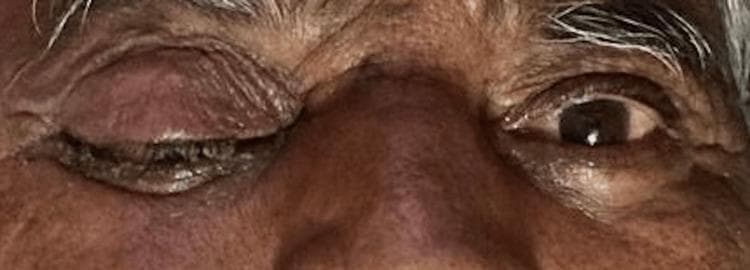 This clinical photograph displays a front-on view of an elderly patient’s face, focusing on the orbital and nasal regions. The primary clinical finding is severe unilateral blepharoptosis (ptosis) of the left eye. The left upper eyelid is significantly drooping, almost entirely obscuring the globe and visual axis. This is accompanied by noticeable periocular edema and erythema, suggesting an inflammatory or infectious process. In contrast, the right eye remains fully open with a normal palpebral fissure width. The surrounding skin shows age-related changes, including deep rhytids and solar elastosis. The presence of ptosis in this context is clinically significant for diagnosing orbital complications associated with invasive fungal infections, such as mucormycosis, or other causes of orbital apex syndrome. The image serves as a clear educational example of acquired ptosis and periocular soft tissue swelling in an ophthalmic or infectious disease context.