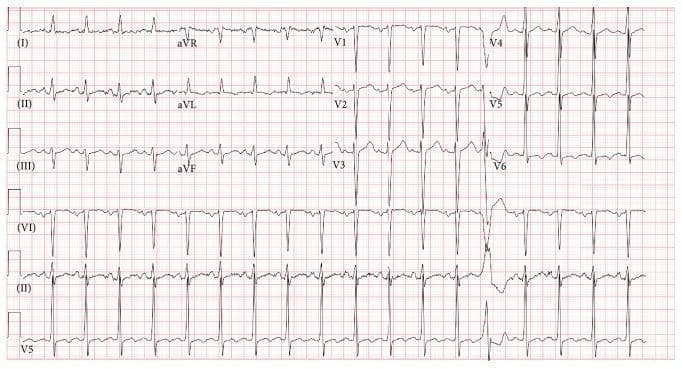 A 12-lead electrocardiogram (ECG) strip presented in a standard grid layout, demonstrating sinus tachycardia and structural cardiac abnormalities. The rhythm is predominantly regular with a rapid rate. A notable feature is the presence of a premature ventricular contraction (PVC) characterized by a wide, bizarre QRS morphology and a compensatory pause, most visible in the precordial leads. The tracing shows signs of left ventricular hypertrophy (LVH), including high voltage QRS complexes in the lateral leads (V4–V6). Nonspecific ST-segment depression and T-wave flattening or inversion are evident in the lateral leads (V4, V5, V6), suggesting possible myocardial ischemia or strain secondary to hypertrophy. Prolongation of the corrected QT interval (QTc) is also observable. Lead aVR shows expected inversions of the P, QRS, and T waves. This diagnostic image illustrates common findings in patients with advanced heart failure and severely reduced ejection fraction, specifically highlighting electrical remodeling and ventricular irritability.