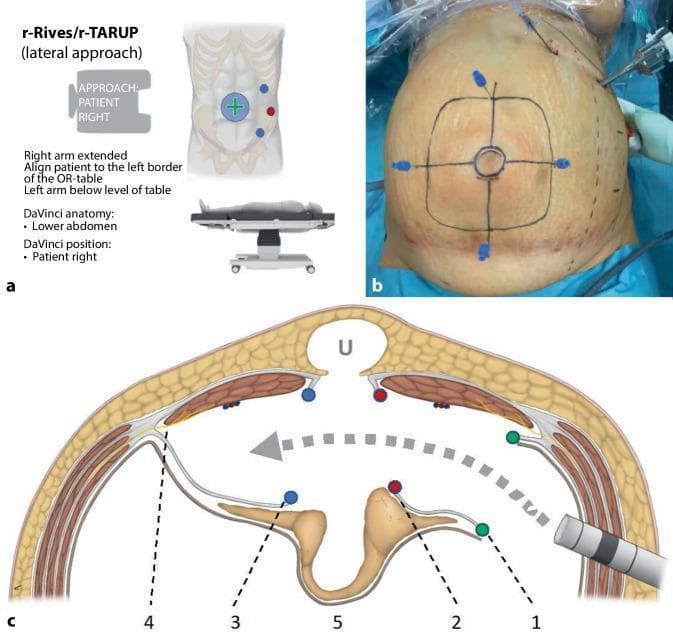 Educational graphic illustrating the surgical planning and anatomy for robotic transabdominal retromuscular umbilical prosthetic hernia repair (r-Rives or r-TARUP) via a left-lateral approach. Figure A shows an infographic detailing patient positioning on the operating table and port placement lateral to the left rectus muscle. Figure B is a clinical photograph of a patient's abdomen under pneumoperitoneum; ink markings delineate the umbilical hernia (central circle) and the anticipated mesh size (outer square). Transparietal needles are inserted at the square's perimeter to guide intra-abdominal preparation. Figure C is a cross-sectional anatomical diagram of the abdominal wall layers (skin, subcutaneous fat, rectus muscles, and posterior rectus sheaths). It maps the surgical dissection path (gray arrow) through the retrorectus space. Key steps are numbered: (1) green dots mark the lateral entry into the left posterior rectus sheath; (2) red dots signify the medial reopening of the sheath near the linea alba; (3) blue dots indicate the entry into the right posterior rectus sheath; (4) identifies lateral nerve preservation zones; (5) shows the mobilized hernia sac and peritoneal bridge. This content serves as a guide for surgical residents and fellows learning complex robotic ventral hernia repair techniques.