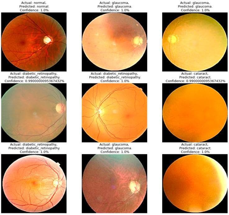 A multi-panel comparison chart of clinical diagnostic images featuring nine color fundus photographs used for ophthalmological screening. The images demonstrate four diagnostic categories: Normal, Glaucoma, Diabetic Retinopathy, and Cataract. The Normal fundus image shows clear retinal architecture, a well-defined optic disc, macula, and healthy vascular branching over a reddish-orange background. Glaucoma images exhibit pathological optic disc cupping and increased pallor. Diabetic Retinopathy images show characteristic vascular changes, including visible hemorrhages and exudates disrupting the retinal surface. Cataract images are characterized by significant media opacity, presenting as a diffuse yellow-brown or amber haze that obscures the posterior pole and retinal landmarks due to lens clouding. Each image is annotated with labels indicating the 'Actual' diagnosis, the 'Predicted' diagnosis by a deep-learning model, and the 'Confidence' score, representing the application of artificial intelligence in medical imaging for automated disease classification in ophthalmology.