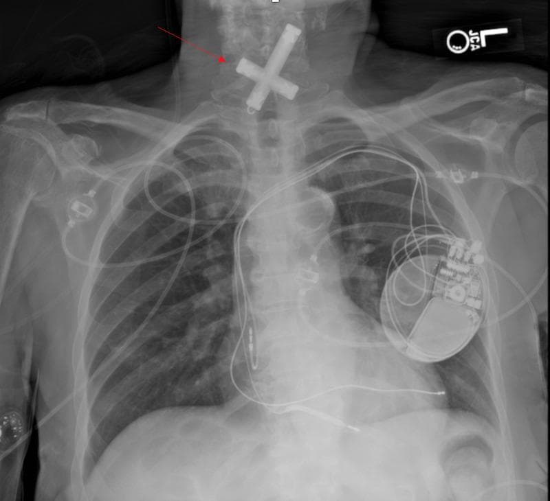 This diagnostic image is a posteroanterior (PA) chest radiograph illustrating an accidental foreign body ingestion. Centered in the upper cervical and thoracic inlet region, projecting over the esophagus, is a large, radio-opaque, crucifix-shaped foreign object. The object exhibits high density, consistent with metal, and is oriented with its longitudinal axis slightly oblique to the midline. In addition to the foreign body, the radiograph shows several medical devices: a dual-chamber cardiac pacemaker or implantable cardioverter-defibrillator (ICD) is visible in the left infraclavicular region with leads extending into the cardiac silhouette. Multiple external monitoring leads and a right-sided vascular access device (likely a PICC line or central venous catheter) are also present. The image serves as a clinical example of esophageal foreign body impaction in an adult patient with comorbid cardiovascular conditions. Educational focus includes the recognition of dense radio-opaque objects on X-ray and the anatomical relationships between the esophagus, airway, and mediastinum.
