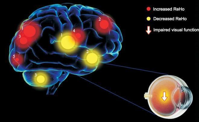 This medical illustration combines a 3D brain model with functional neuroimaging data to demonstrate the pathophysiology of strabismus amblyopia (SA). The diagram highlights changes in Regional Homogeneity (ReHo) values within the brain, representing local neural synchrony. Red circular markers signify increased ReHo, localized to the right lingual gyrus (BA 18), right superior frontal medial area (BA 8), and bilateral parietal regions (superior BA 7 and inferior BA 40). Yellow circular markers denote decreased ReHo, situated in the left putamen, left superior frontal gyrus (BA 13), and right cerebellum. The size of the markers indicates the degree of quantitative change. Accompanying the brain model is a cross-sectional diagram of a human eye with a downward-pointing arrow, symbolizing impaired visual function. The integration of these elements illustrates the correlation between peripheral ocular dysfunction and central nervous system reorganization, specifically emphasizing how strabismus impacts visual processing pathways and cortical synchronization.
