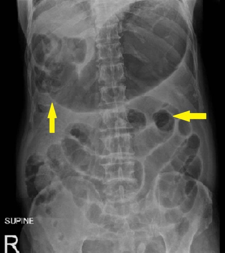 This diagnostic image is a supine plain abdominal radiograph (X-ray) illustrating significant gastrointestinal pathology. The primary finding is marked gastric distension, characterized by a large, gas-filled stomach shadow occupying the upper left quadrant and crossing the midline. Additionally, multiple dilated small bowel loops are visible throughout the central and lower abdominal regions, demonstrating pathologically increased luminal diameter. Yellow arrows highlight specific areas of gaseous distension and prominent bowel loops. The valvulae conniventes are visible within the dilated loops, identifying them as small bowel. There is a notable absence of significant colonic gas or pneumoperitoneum in this projection. These radiographic signs are highly suggestive of an intestinal obstruction or generalized ileus. The image serves as a clinical example of mechanical bowel obstruction or gastric outlet obstruction for medical education, emphasizing the radiographic appearance of dilated hollow viscera and the importance of supine imaging in initial diagnostic workups for acute abdominal pain.
