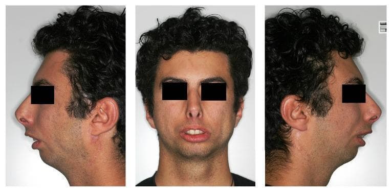 This set of clinical photographs displays the extraoral facial features of a male patient in frontal and bilateral profile views, illustrating classic manifestations of Moebius syndrome and severe skeletal class II malocclusion. The profile views demonstrate a markedly convex profile characterized by severe micrognathia and a retrognathic mandible, leading to a receding chin and an obtuse nasolabial angle. The frontal view reveals a 'mask-like' facies with reduced expression, secondary to congenital bilateral facial nerve palsy. Key visible findings include lip incompetence with a significant interlabial gap at rest, exposing the maxillary incisors, and reduced lower anterior facial height. The soft tissue presentation shows lack of muscular tension in the perioral region and slight flatness of the cheeks. These images serve as educational material for maxillofacial surgery and orthodontics, highlighting the relationship between skeletal hypoplasia and neuromuscular dysfunction in complex craniofacial conditions.