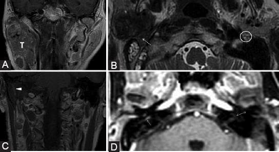 This composite of magnetic resonance imaging (MRI) scans demonstrates a right-sided parotid adenocarcinoma with retrograde perineural spread (PNS) along the facial nerve (CN VII). Image A (coronal contrast-enhanced T1-weighted) shows a large heterogeneous tumor (T) involving both superficial and deep lobes of the right parotid gland. Image B (axial T2-weighted) highlights the effacement of the normal high-signal fat pad at the right stylomastoid foramen (dashed arrow), contrasted with the preserved fat pad on the left (white circle). Image C (coronal contrast-enhanced T1-weighted) illustrates pathological contrast enhancement (arrowhead) along the mastoid segment of the right facial nerve, indicating retrograde neural invasion. Image D (dynamic contrast-enhanced sequence) reveals asymmetric enhancement extending to the right tympanic segment (single arrow) compared to the normal left side (double arrow). These findings are characteristic of malignant perineural tumor dissemination, resulting in the obliteration of normal anatomical fat planes and pathological enhancement of cranial nerve segments, correlating with the patient's presentation of peripheral facial palsy.