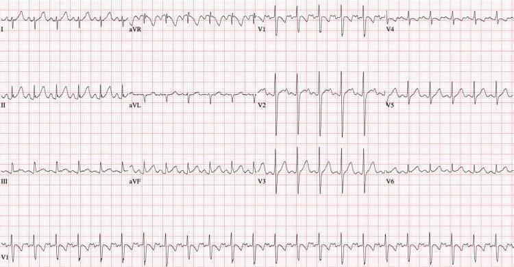 This diagnostic image is a 12-lead electrocardiogram (ECG) demonstrating a normal sinus rhythm in a pediatric patient following pharmacological conversion from idiopathic ventricular tachycardia. The tracing shows a regular heart rate of approximately 110 beats per minute. Key features include identifiable P waves preceding every QRS complex with a consistent PR interval, indicating successful restoration of sinus rhythm. The QRS complexes are narrow (<100 ms), suggesting normal ventricular conduction without bundle branch block or accessory pathway evidence. T waves are prominent and upright across most leads, particularly in the precordial leads V2-V4. The rhythm strip (lead V1) at the bottom confirms rhythmic consistency and the presence of P-QRS-T sequences. This ECG serves as an educational reference for normal cardiac electrical activity after the resolution of a wide complex tachycardia (WCT) using antiarrhythmic therapy such as procainamide.